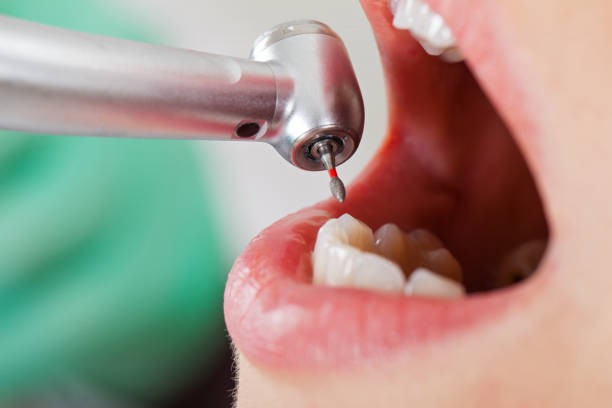 Best Broken or Cracked Tooth Emergency Dentist in Hamlet, NC